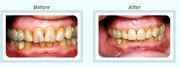 Porcelain Crowns and Veneers Treatment by Healthy Smiles 