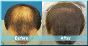 FUE Hair Transplant in Australia