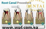 The best Root Canal Treatment in west Perth dental centre at Australi