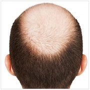 Male Hair Transplant Prices - Male Hair Transplant Cost Australia