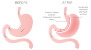 Find Gastric Sleeve Surgery Specialist in Perth, Australia
