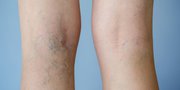 Long-Term Relief Spider Vein Treatment in Melbourne