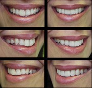 Best Porcelain Veneers Sydney | Cosmetic Dental Treatments