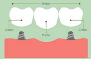 Cost of Crown Tooth – Crowns Dentist Cost